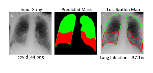 COVID-19 X-ray detection project